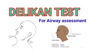 DELIKAN TEST AIRWAY ASSESSMENT  EASY WAY TO PREDICT DIFFICULT LARYNGOSCOPY AND Intubation [upl. by Eserahc]