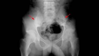 Ankylosisng spondylitis [upl. by Laddie]