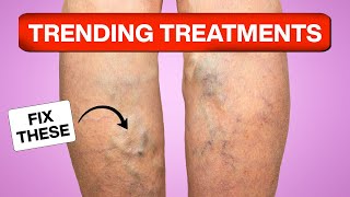 The BEST VARICOSE VEINS Treatments and Trends of 2024 [upl. by Joappa]