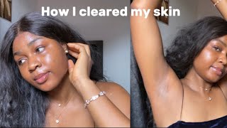 How I cleared my skin in 2 weeks using this few skincare products  Skincare routine [upl. by Nioe]