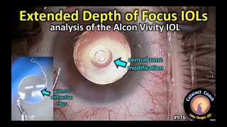 Extended Depth of Focus IOLs EDOF Lens for cataract surgery  Alcon Vivity [upl. by Fondea]