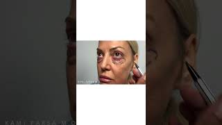 Lower Eyelid Blepharoplasty After Removing Tear Trough Filler  Dr Kami Parsa [upl. by Grassi]