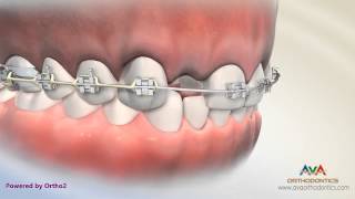 Orthodontic amp Restorative Treatment for Missing Lateral Incisor  Different Options [upl. by Eilah794]