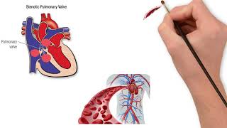 Pulmonary valve stenosis [upl. by Kimbell]