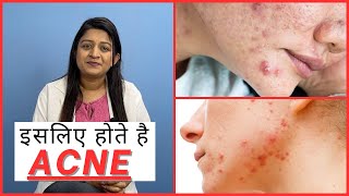 Acne Reason on Face  Acne Treatment [upl. by Mohkos]