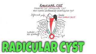 Radicular cyst  Periapical Cyst  Pathogenesis Clinical RF HF amp Treatment [upl. by Skilken495]