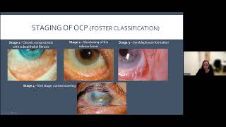 Cicatrizing Conjunctivitis דלקת לחמית מצלקת [upl. by Ogeid886]