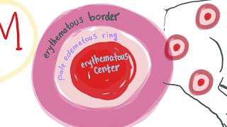 Erythema Multiforme with mnemonic  ALL you need to know [upl. by Ahsiliw345]