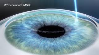 3rd Generation SMILE Laser Eye Surgery  Revolutionary bladeless procedure [upl. by Koralle]