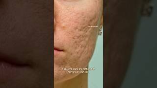 How to get rid of acne scars with Tretinoin  Acne scar Treatment sristydutta acnescars shorts [upl. by Pernas]