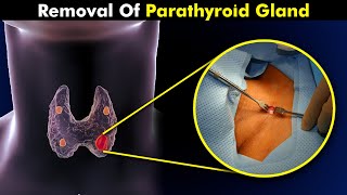 How Parathyroidectomy is Performed  Removal Of Parathyroid Gland [upl. by Snow]