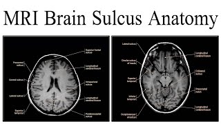 MRI Brain Sulcus Anatomy [upl. by Strade153]