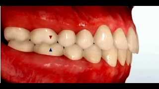 Class II Malocclusion [upl. by Aneloc]