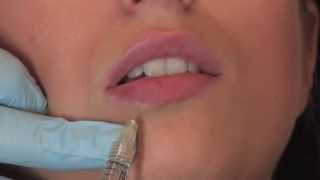 Lippenunterspritzung mit Juvederm Volbella  PULLMANN [upl. by Hutson]