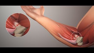 Medial Epikondilit  Golfçü dirseği  Medial Epicondylitis  Golfers elbow [upl. by Paucker]