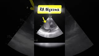 Parasternal short Axis View showing RA myxoma on Echocardiography heart tumor [upl. by Jeffers]