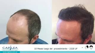 Alopecia grado 4A [upl. by Delmer]