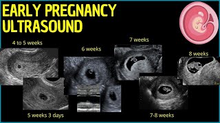 Early Pregnancy Ultrasound A Deep Dive into First Trimester Insights pregnancyultrasound [upl. by Dahsraf579]