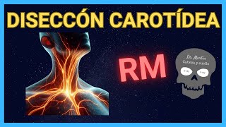 DISECCIÓN CAROTÍDEA 👉en RESONANCIA Magnética [upl. by Ydde]