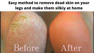 Remove dead skin from your feet in 5 minutesquotEasiest method at homequot [upl. by Mara314]