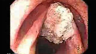 Cancer of the larynx vocal cords cancer [upl. by Dupre]