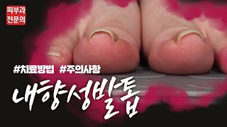 내성발톱 내향성 발톱이 당신의 일상을 괴롭힌다면 한 번 클릭해보세요 내향성 발톱 치료방법과 주의사항 [upl. by Peskoff]