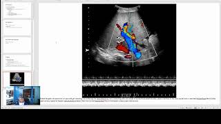 Hepatic Venoocclusive Disease [upl. by Aynotahs]