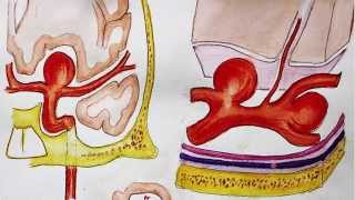 Understanding Brain aneurysm and endovascular coiling [upl. by Eintruok291]