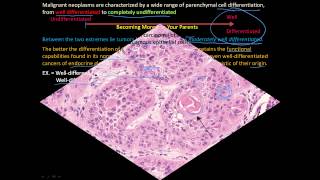 113P How to tell a benign and malignant tumor apart Differentiation and Anaplasia [upl. by Werby]