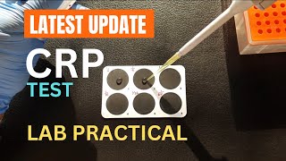 CRP test  C reactive protein test  Procedure [upl. by Joanna]