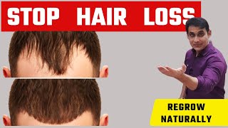 STOP HAIR FALL amp REGROW HAIR  Hair Fall Hair Thinning And Receding Hairline [upl. by Esoj]