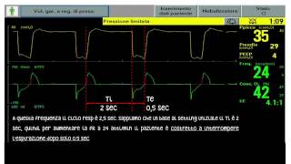 Rapporto IE durante ventilazione meccanica [upl. by Aivekahs538]