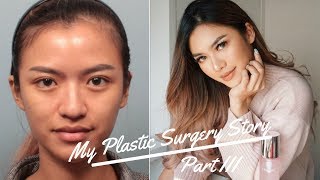 MY PLASTIC SURGERY STORY PART 3 END RESULT ENG SUB BAHASA INDONESIA [upl. by Yelnik]