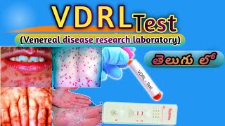 VDRL Test Venereal disease research laboratoryMLTTeluguLabVDRL Test తెలుగు లో [upl. by Varrian651]