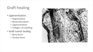 Graft choices autograftallograftsyntheticxenograft  Session 4  11h50  Ciaran McGarvey [upl. by Fallon]