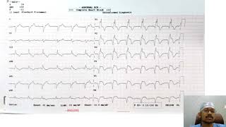 Interpretation of an Anterior wall MI ECG [upl. by Sousa]