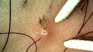 Plucking Hair and Blackheads with Tweezers [upl. by Tiebold]