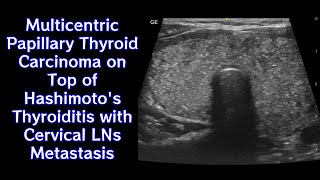 Multicentric Papillary Thyroid Carcinoma on Top of Hashimotos Thyroiditis with Cervical LNs Mets [upl. by Zephan730]