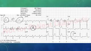 EKG befunden leicht gemacht EKG Beispiele [upl. by Dloreh596]