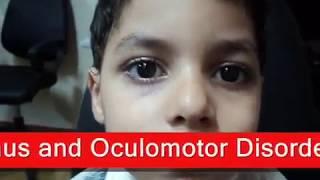 Intermittent Exotropia  الحول الوحشي المتقطع [upl. by Yggam]