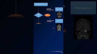 Imaging differential for Cerebellopontine Angle CPA masses radiology MRI tumors [upl. by Notniuq]