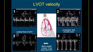 Guidelinebased Webinar on the Echo Assessment of Aortic Valve Stenosis [upl. by Klapp453]