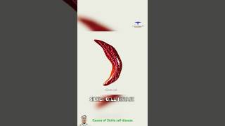 Causes of Sickle cell disease  cell sickle [upl. by Matuag]