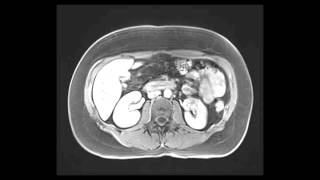 Hepatic adenomatosis with Eovist MRI [upl. by Jemima355]