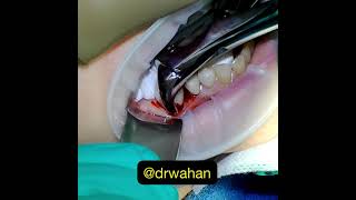 Cowhorn Dental Extraction Video [upl. by Eerdna]