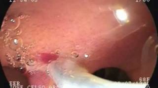 Duodenal carcinoid tumor  endoscopic resection after EUS [upl. by Lanza]