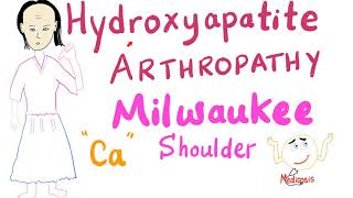 Hydroxyapatite Arthropathy  Milwaukee Soulder [upl. by Anirok935]