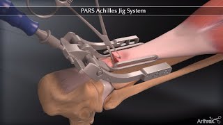 PARS Achilles Jig System [upl. by Ardnohs]