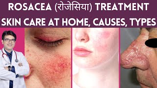 Rosacea Treatment Skin Care Laser Treatment  Rosacea का इलाज  Rosacea Causes Types  Hindi [upl. by Rena392]