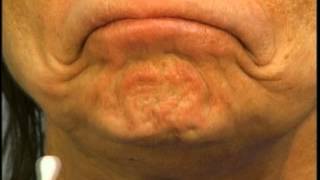 Instructions for Using Botox in the Chin by Dr Elliott of Skinspirations [upl. by Dory]